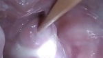 Insertion Semen Cum in Cervix Wide Stretching Pussy Speculum